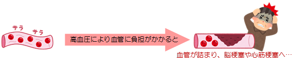 高血圧による血管のつまりの説明画像